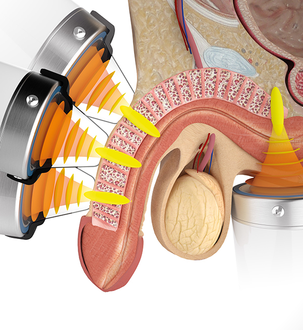 Shockwave Therapy